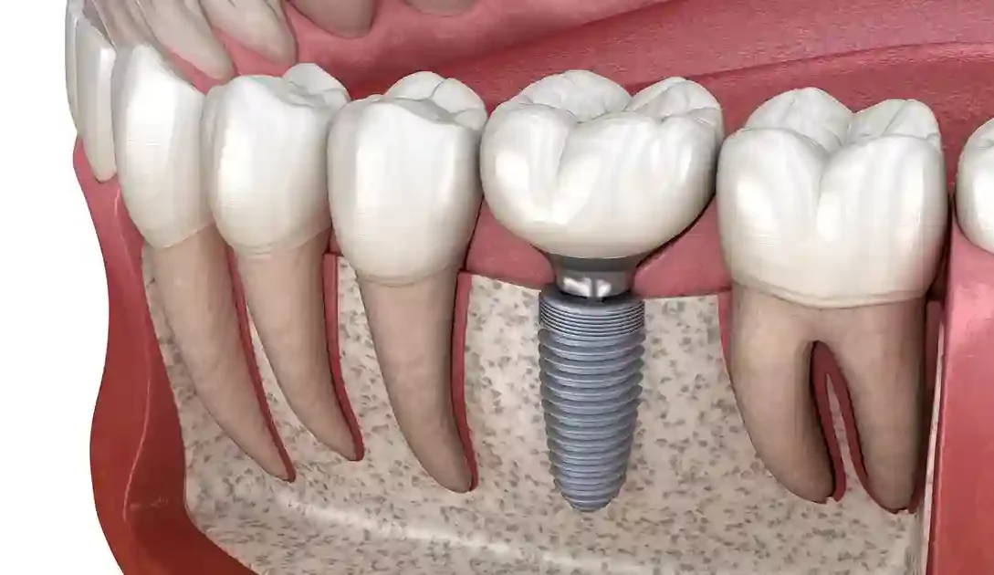 Dental Implants