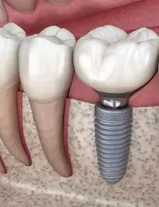 Dental Implants